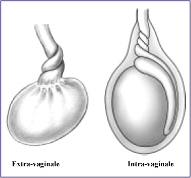 LEXIPatho: Torsion du cordon spermatique