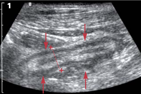 Aspect échographique d’appendicite : les parois appendiculaires sont épaissies avec une bonne différenciation pariétale et le diamètre appendiculaire est augmenté.